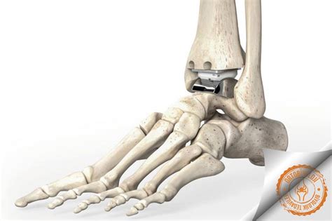 ayak bileği protezi